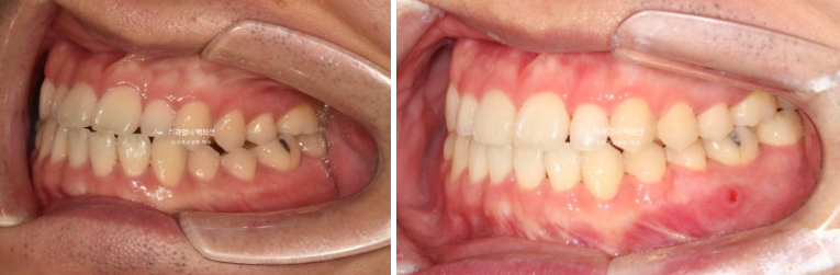 주걱턱 교정 반대교합 소구치 선천적 결손 부정교합 비발치 교정 후기 관련 이미지 11