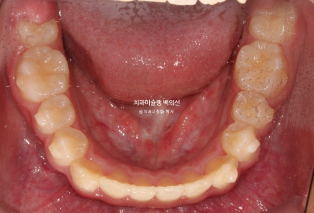 덧니 반대교합 과개교합 인비절라인 퍼스트 악궁확장 어린이 교정 관련 이미지 8