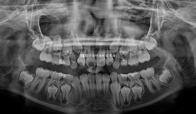 어린이교정 투명교정 인비절라인 퍼스트 후기 관련 이미지 2