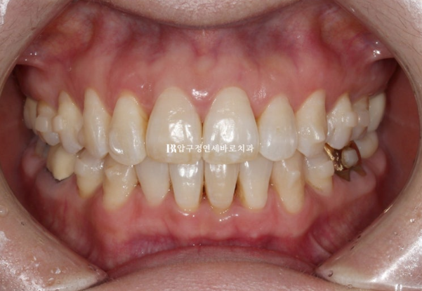 50대 치아교정 인비절라인 라이트 앞니교정 치료 후기 관련 이미지 6