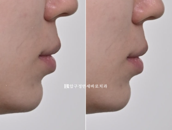 웃을 때 잇몸이 보여요. 잇몸미소 거미스마일 교정하기 관련 이미지 13