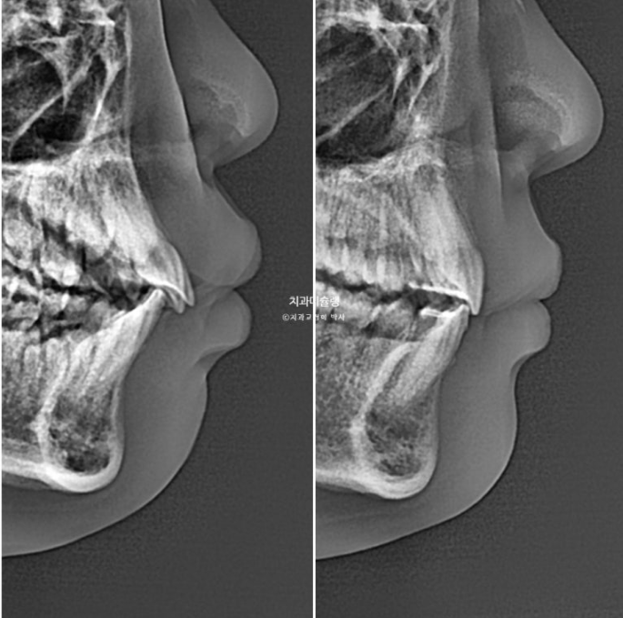 선천적 결손 잔존유치 과개교합 돌출입 인비절라인 퍼스트 어린이 투명교정 치료기간 관련 이미지 26