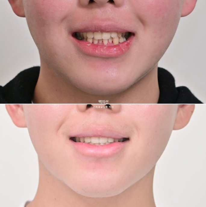 유학생 교정 인비절라인 라이트 치료기간 5개월 관련 이미지 16