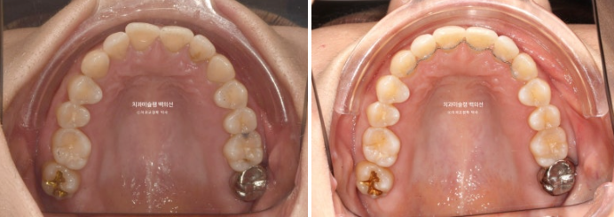 해외거주 앞니 선천적 결손 과개교합 인비절라인 라이트 브릿지 치료 관련 이미지 15