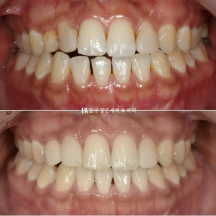 왜소치 치료 잔존유치 무삭제 라미네이트 후기 관련 이미지 1