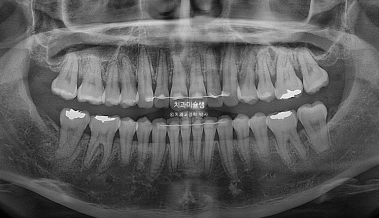 비발치 돌출입 인비절라인 교정 가위교합 중심선 맞추기 관련 이미지 27