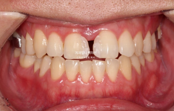 MSE Palatal Expansion Invisalign Underbite Correction, Non-Surgical image 6