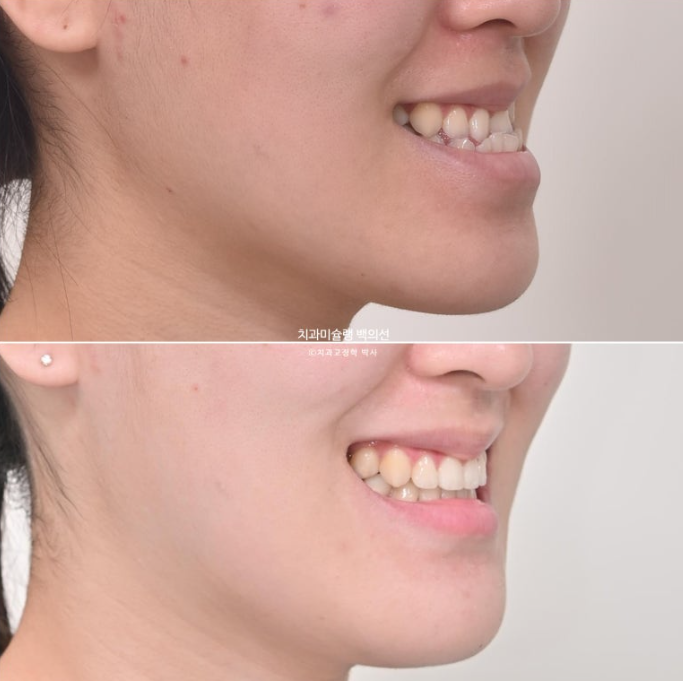 비수술 주걱턱 비대칭 발치 교정 결손치 반대교합 클리피씨 치료기간 1년 11개월 관련 이미지 17