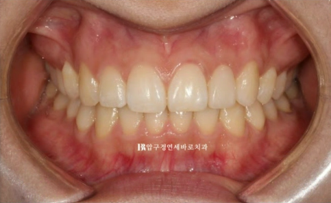 급속 교정 앞니부분교정 치료 무삭제 라미네이트 후기 관련 이미지 9