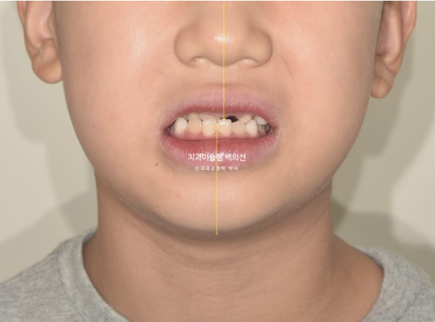 어린이 비대칭 반대교합 주걱턱 인비절라인 퍼스트 프리올소 성장 교정 관련 이미지 5