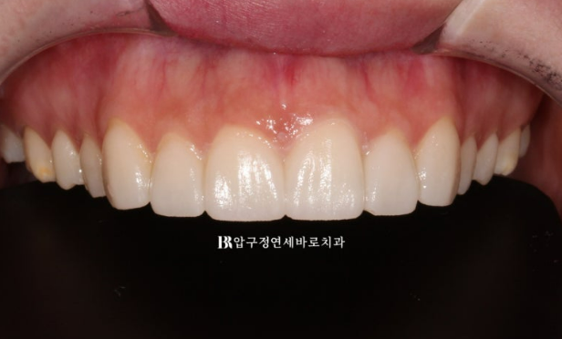 How to Create a Beautiful Smile Line? | A Real Case of Changing a Smile with No-Prep Laminates image 7