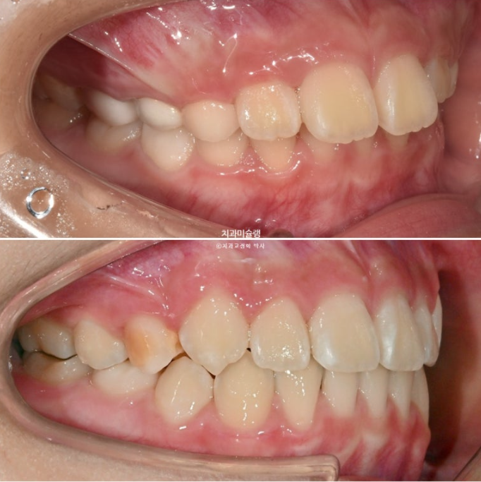 어린이 돌출입 교정 무턱 투명교정 인비절라인 퍼스트 관련 이미지 20