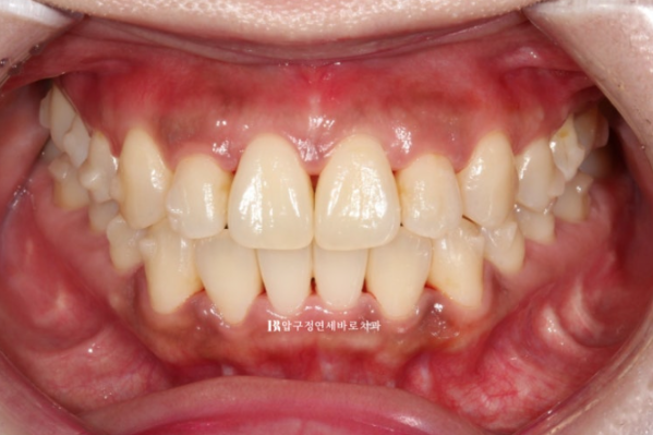 Invisalign Success Depends on Wearing Them Consistently|9-Month Real Treatment Case of Crowding & Underbite image 6