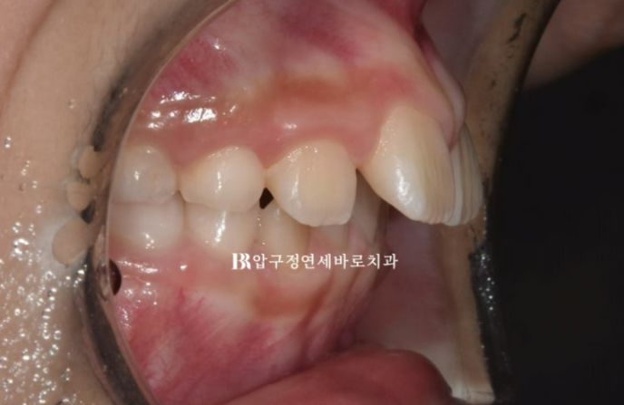 무턱교정 어린이 투명교정 인비절라인 퍼스트 교정 후기 관련 이미지 3