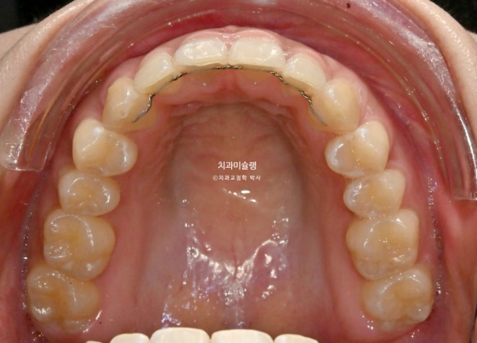 선수술 양악수술 비대칭 주걱턱 잇몸미소 치료 인비절라인 라이트 관련 이미지 15