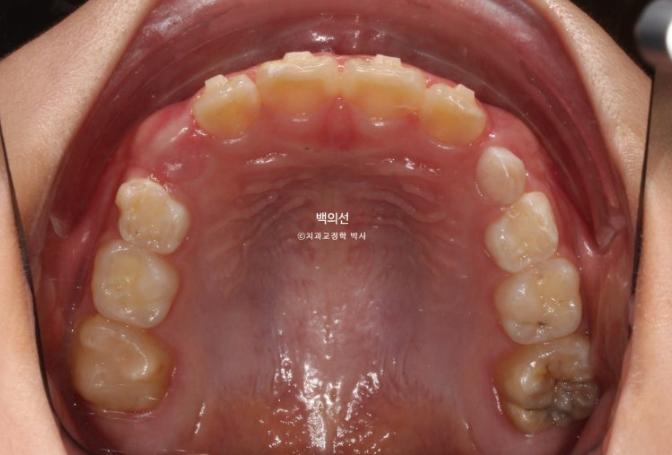 소아 비대칭 교정 인비절라인 퍼스트 재제작 1회 MA 치료 관련 이미지 9