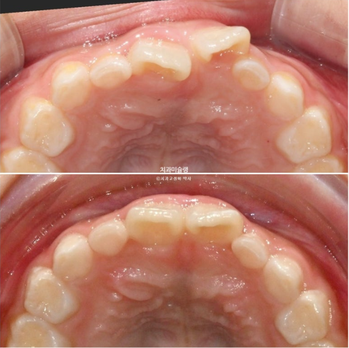 7세 어린이 반대교합 부정교합 프리올소 치료 관련 이미지 11