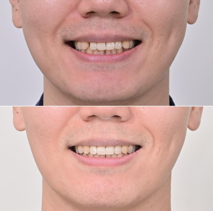 가위교합 벌어짐 중심선 과개교합 인비절라인 라이트 교정 관련 이미지 1