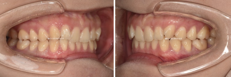 옥니 교정 인비절라인 라이트 옹니 덧니 치료기간 ? 관련 이미지 3