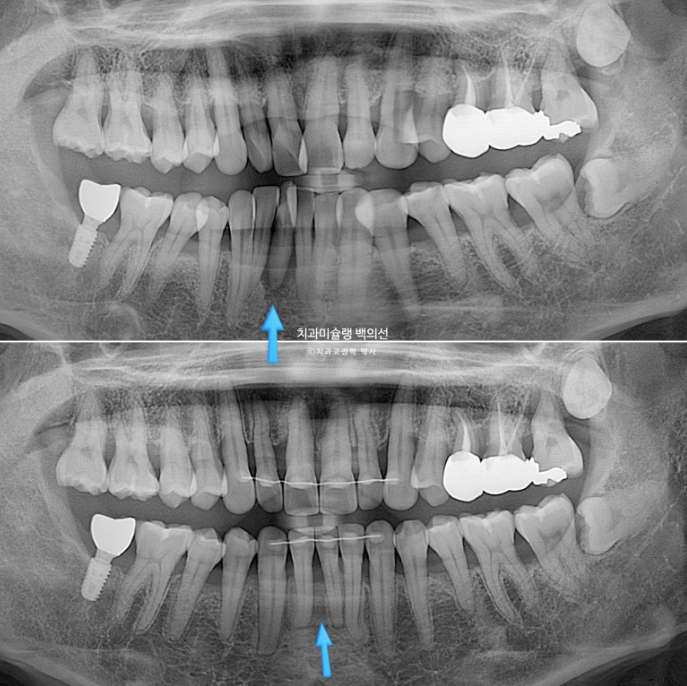 50대 치아교정 중년 발치교정 블랙트라이앵글 치료 후기 관련 이미지 24