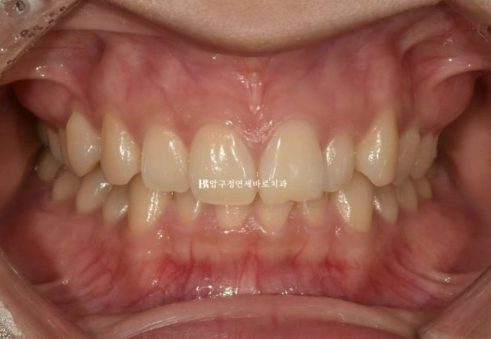 급속 교정 앞니부분교정 치료 무삭제 라미네이트 후기 관련 이미지 2
