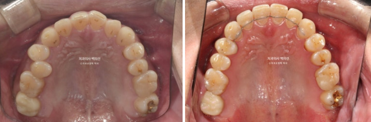 30대 주걱턱 비수술 비발치 교정 후기 관련 이미지 12