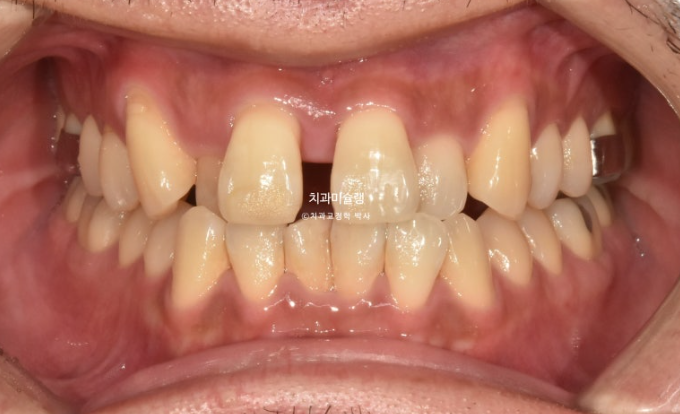 30대 MSE 악궁확장 덧니 반대교합 비발치 클리피씨 부작용 관련 이미지 7