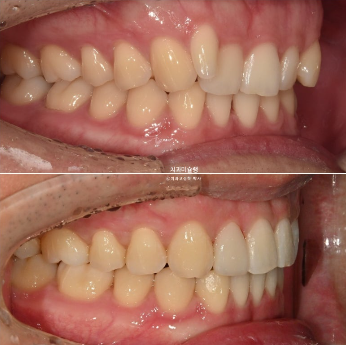 옥니 덧니 교정 왜소치 선천적 결손 3전치 무삭제 라미네이트 인비절라인 교정 관련 이미지 21