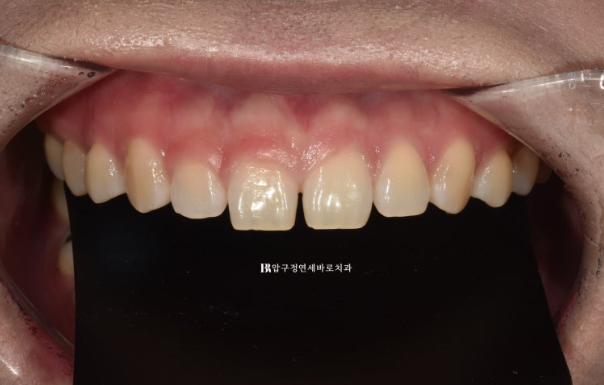 Four No-Prep Veneers for Dwarf Teeth and Conical Front Teeth image 2