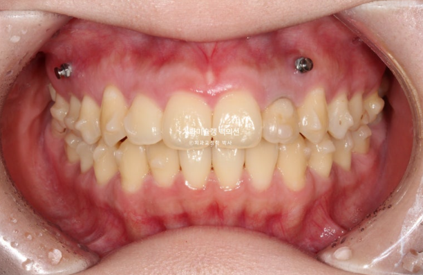 잇몸미소 인비절라인 거미스마일 토끼이빨 교정 무삭제 라미네이트 반대교합 치료 후기 관련 이미지 14