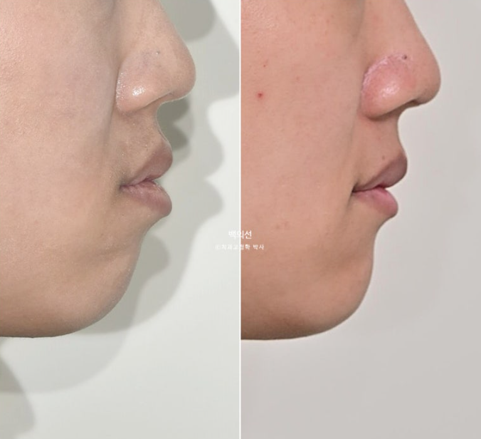 거미스마일 교정 돌출입 발치교정 입술부전 호두턱 치료기간 2년반 관련 이미지 25