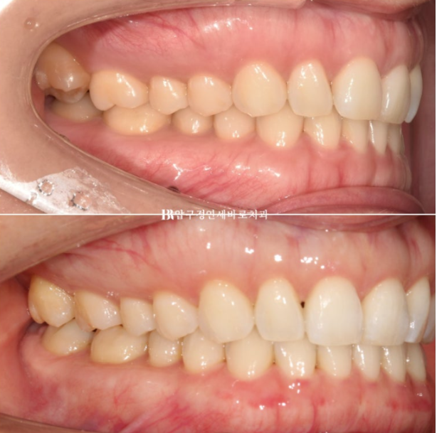 인비절라인 라이트 가위교합 벌어짐 중심선 미니스크류 치료기간 11개월 관련 이미지 10