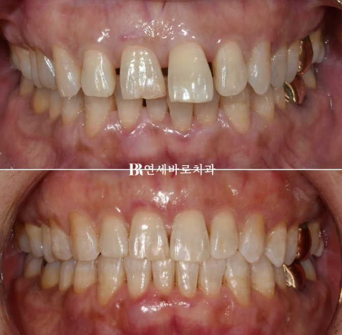 50대 치아벌어짐 단기 교정 가능할까요? 관련 이미지 5