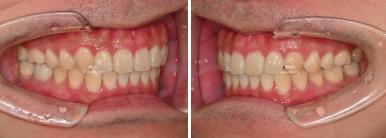 가위교합 나비치아 미니스크류 덧니 교정 인비절라인 라이트 관련 이미지 17