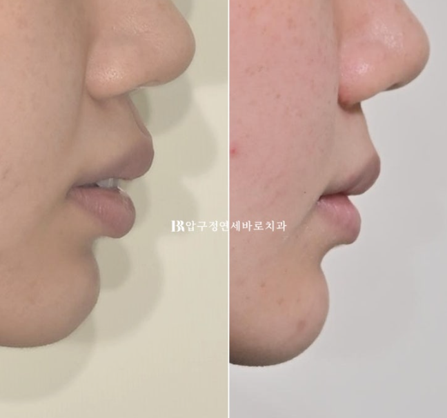 돌출입 발치교정으로 거미스마일&middot;잇몸미소&middot;입술부전까지 개선한 사례｜입동굴 변화까지 확인해보세요 관련 이미지 17