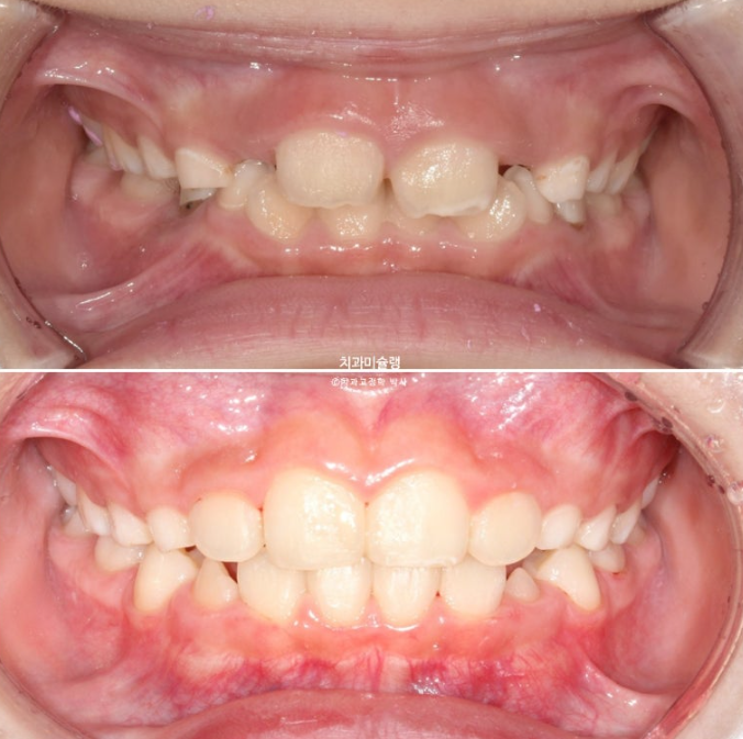 어린이 투명교정 인비절라인 퍼스트 과개교합 교정 후기 관련 이미지 1