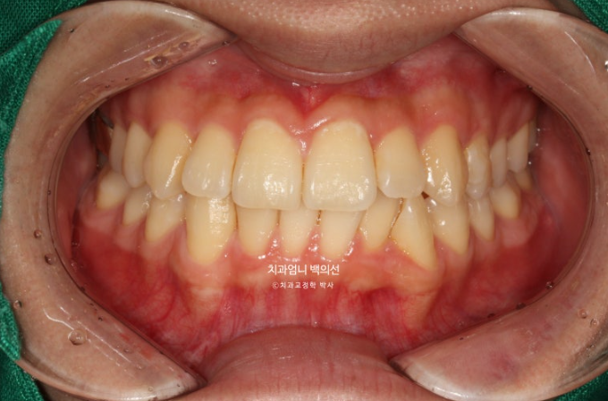 인비절라인 비발치 앞니 돌출 덧니 교정 ? 관련 이미지 2