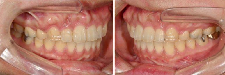 Extraction Orthodontics with Clippy-C for Protruding Mouth, Gum Smile, Gummy Smile Correction, and Treatment for a Recessed Chin image 11