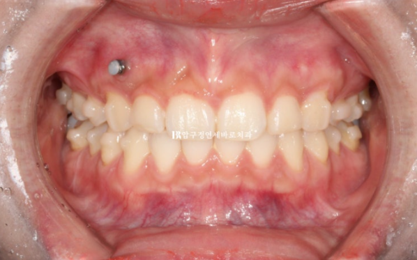 Can't Invisalign Move the Roots? An Actual Case of Extraction Treatment for Protruding Mouth at a Gangnam Orthodontic Clinic image 6