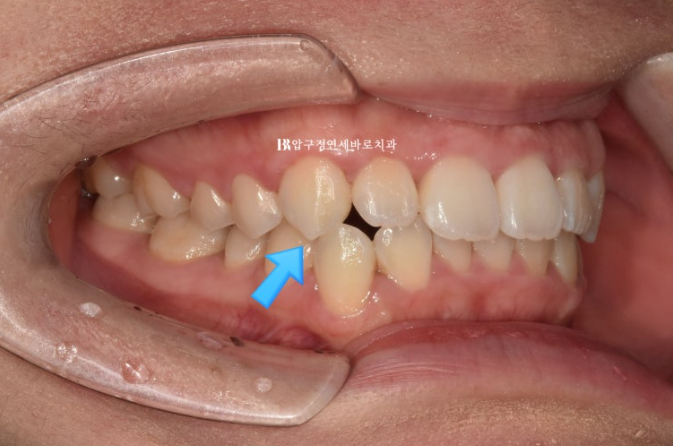 인비절라인 라이트 과개교합 반대교합 돌출입 뻐드렁니 교정 치료 관련 이미지 3