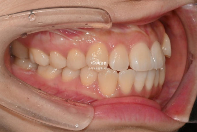 인비절라인 라이트 반대교합? 덧니 중심선 치간삭제 치료 관련 이미지 3