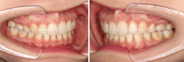 30대 돌출입 발치교정 입술부전증 치료 관련 이미지 10