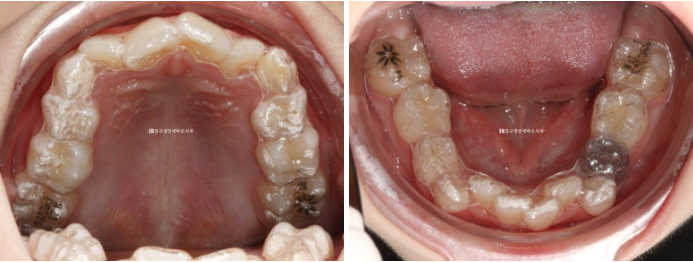 소아 투명교정 인비절라인 퍼스트 후기 기록 관련 이미지 4
