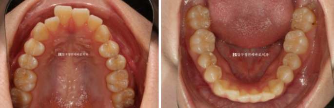 Orthodontic Treatment for International Students: Is Short-Term Treatment Possible in Korea? | A Real 5-Month Front Teeth Partial Orthodontic Case image 3