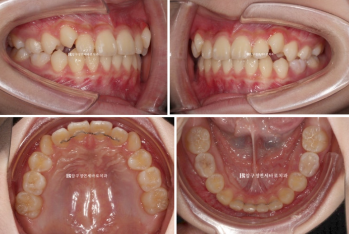 어린이교정 투명교정 인비절라인 퍼스트 후기 관련 이미지 7