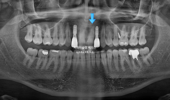 앞니 선천적 결손 인비절라인 임플란트 과개교합 치료 기간 관련 이미지 19