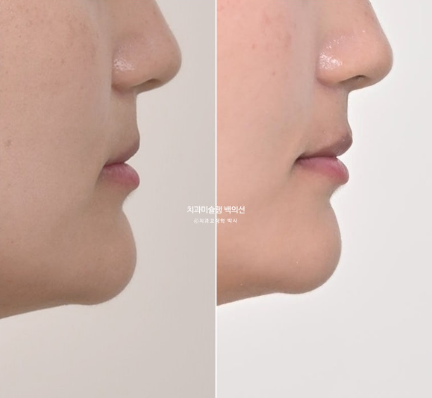 옥니 덧니 과개교합 반대교합 중심선 인비절라인 치료기간 1년 관련 이미지 20