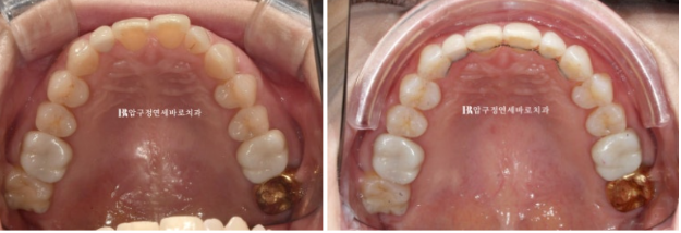 40대 인비절라인 라이트 가위교합? 관련 이미지 15