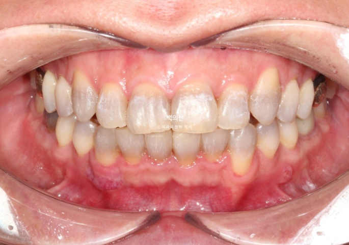 Treatment Review: No-Prep Laminate for Tetracycline-Stained Teeth image 10