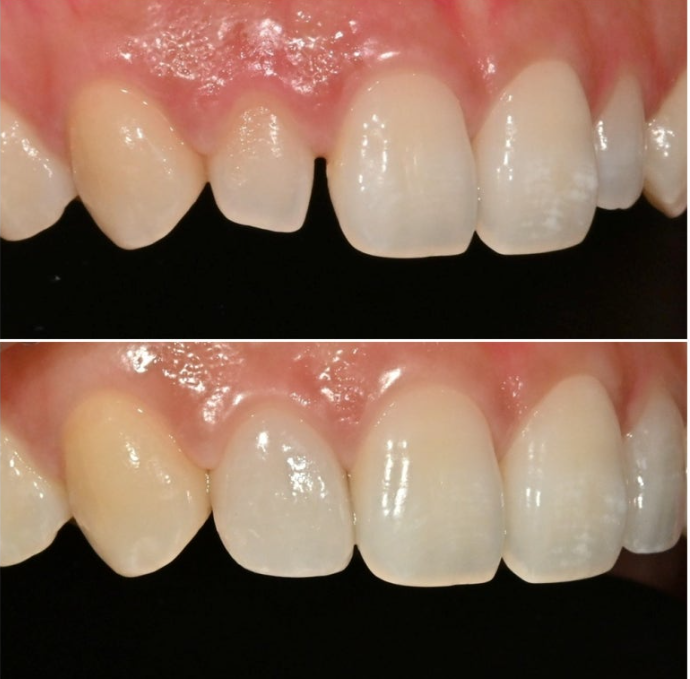 왜소치 반점치 (반상치)가 있는 경우 무삭제 라미네이트 치료 관련 이미지 6